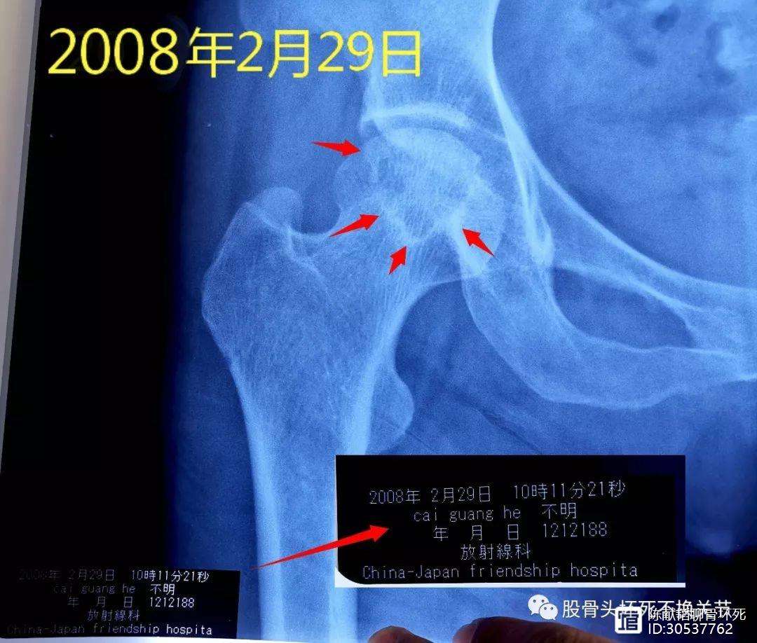 四平人工骨头医保报销多少(人工骨头医保报销多少比例)