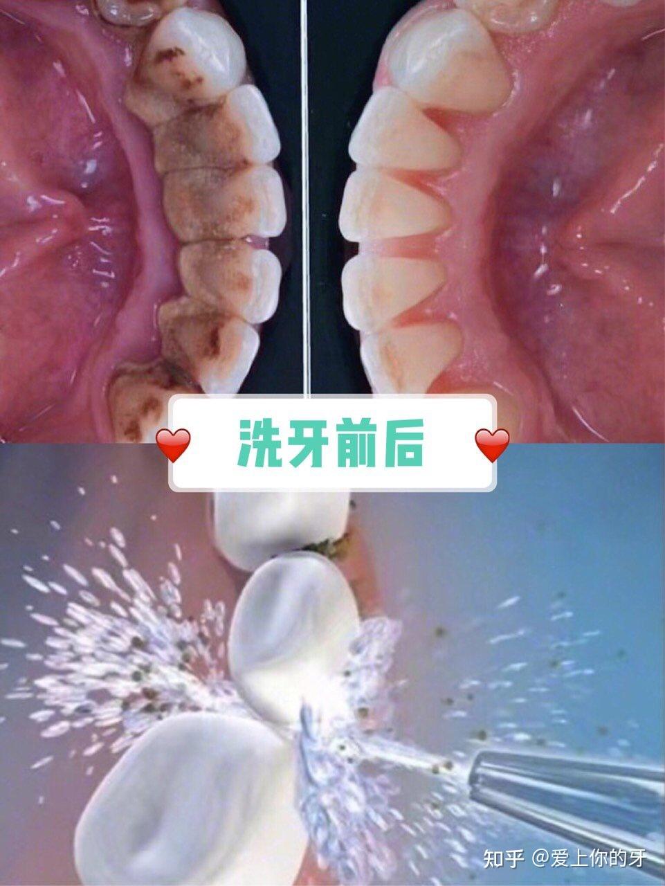 四平洗牙可以用医保吗(洗牙可以用医保吗,报销比例多少)